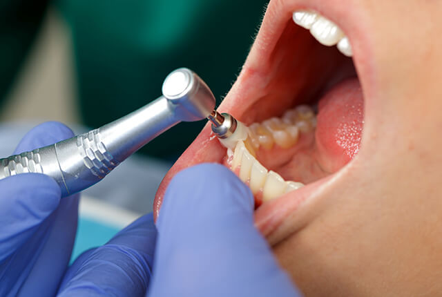歯科での予防